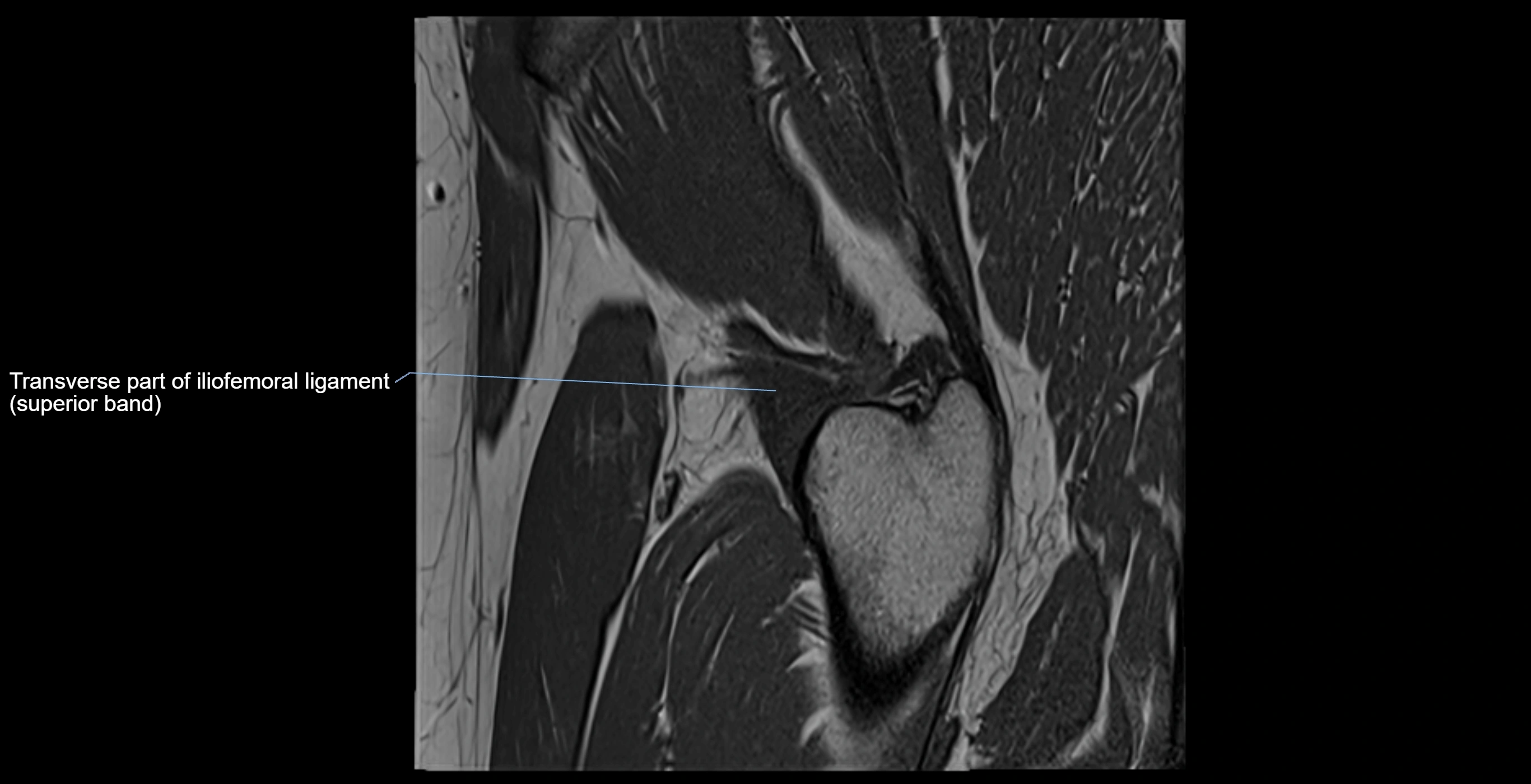 MRI Hip ligaments sagittal cross sectional anatomy 3T  radiology  image-img-00001-00020.webp